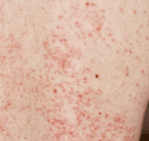a skin rash